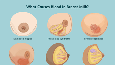 Is It Safe to Breastfeed If There Is Blood In Breast Milk?