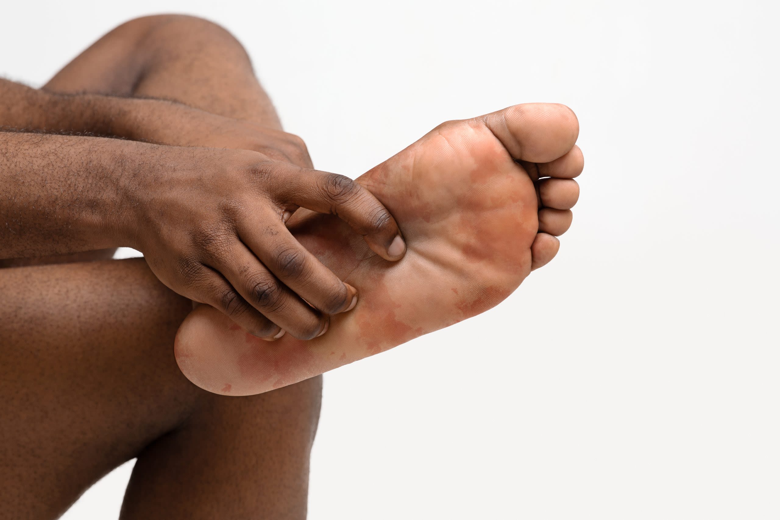 Gout: The Extremely Painful “Unwalkable Disease” - The Baltimore Times