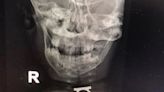 Doctors remove ring from toddler’s throat after two year old swallowed mother’s jewellery