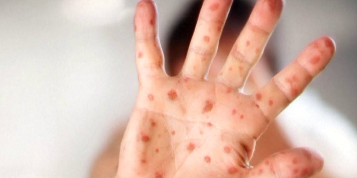 Health officials confirm measles case in Vermont