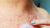 Psoriasis or Eczema: Similarities, Differences, and Treatment