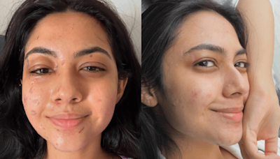 Reem Shaikh shares before and after burn injury pictures from Laughter Chefs: "I've healed"