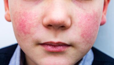 Parvovirus, aka 'slapped cheek disease' is on the rise. These are the signs