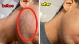 I Haven't Clean-Shaven My Face In Three Years Because I've Struggled With Ingrown Hairs, So I Tried This Hair...