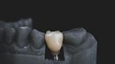Something to chew on – Dental implants may not be for everyone