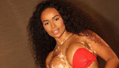 Natália Deodato reflete sobre representatividade no Dia Mundial do Vitiligo