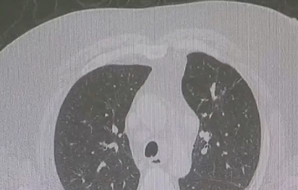 Survival rates for lung cancer are improving: American Lung Association