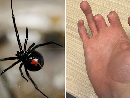 Man has fingers amputated after shocking spider bite on holiday in Ibiza