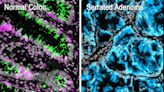Researchers identify the initial steps in colorectal cancer formation