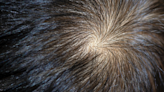 The swirls and whorls of your hairline come from multiple genes