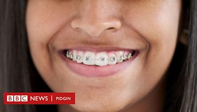 Braces for fashion: E don turn trend for Nigeria?