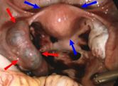 Ectopic pregnancy