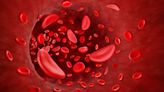 1st gene therapies for sickle cell cleared by FDA, including CRISPR treatment