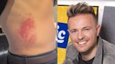 Westlife’s Nicky Byrne shows off injuries after being left ‘battered and bruised’ falling through stage