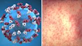 UGA, Penn State research team to develop new model to predict measles outbreaks