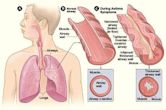 Pathophysiology of asthma