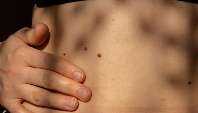 What is Melanoma? 5 Symptoms That Signal This Deadly Skin Cancer