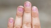 Perigo na ponta dos dedos: entenda por que você precisa limpar as unhas - Portal Drauzio Varella