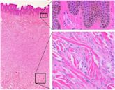 Dermatofibroma