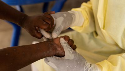 As mpox continues to cross borders, is the US prepared for an outbreak?