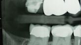 PTSD Triples Odds for Teeth Grinding, Study Finds