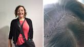 Woman put her bulging eye down to tiredness—it was actually a sign of a brain tumour