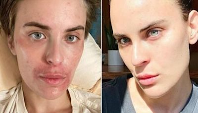 Bruce Willis' daughter shares photos of journey with skin-picking disorder, celebrates 'small wins'