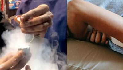 12-YO Girl Develops Hole In Stomach After Eating Smoky Paan With Liquid Nitrogen, Here's What Happened Next