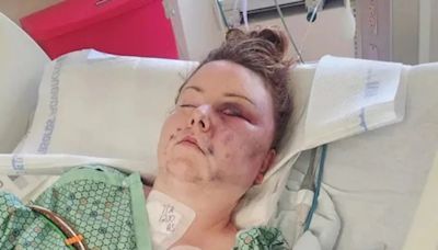 Good Samaritans Save Woman Stabbed, Set On Fire By Husband