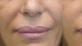 Nasolabial Fold Treatment for Lines Around Your Mouth