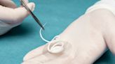 Kerecis unveils Shield Spiral device for advanced wound care