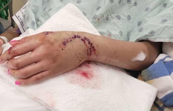 Shark at Galveston Beach bites teen, leaves severe injuries: 'I started punching it'