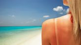 How to treat a sunburn: Dermatologists share their best advice