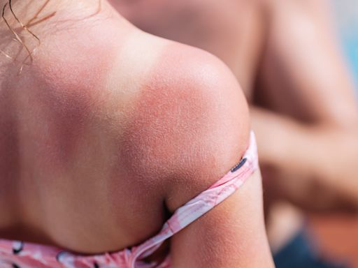 What causes skin cancer? What to know about basal cell carcinoma and symptoms