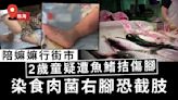 食肉菌｜陪嫲嫲行街市2歲童疑遭魚鰭拮傷腳 染食肉菌右腳恐截肢