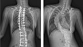 少女脊椎側彎90度 AR輔助矯正手術長高10公分 - 自由健康網