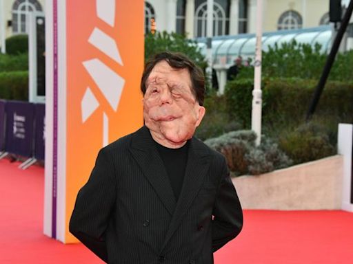 Qu’est-ce que la neurofibromatose, la maladie dont souffre l’acteur Adam Pearson ?