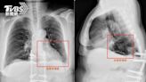 五旬婦從不抽菸咳出血絲 醫一查支氣管「塞滿黃痰」患這病