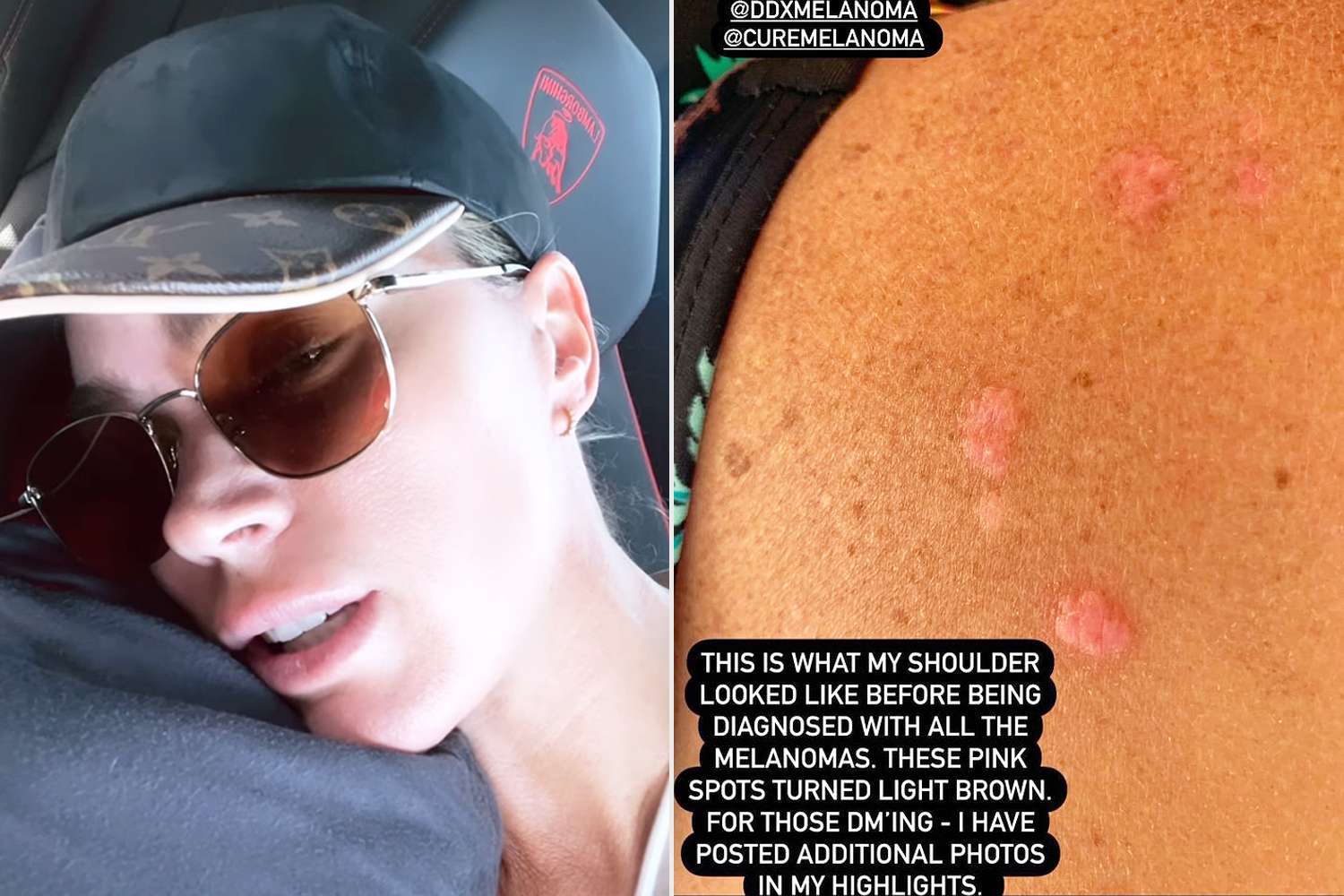 'RHBH' Alum Teddi Mellencamp Has 16th Melanoma Removed: 'So Emotional'