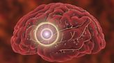 Hemorrhagic Stroke a Key Driver of Spike in US Stroke Rates