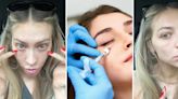 ‘I notice these 2 dimples’: Woman warns against under eye filler, shares why she regrets it 2 years later