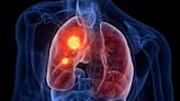 'Outstanding' Results for Osimertinib: Stage III EGFR+ NSCLC