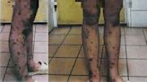 雙腿被針刺成蜂窩！19歲少女遭輪暴「針刺酷刑」逼賣淫 惡男重判15年