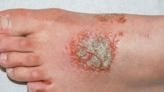 What Are Eczema Blisters?