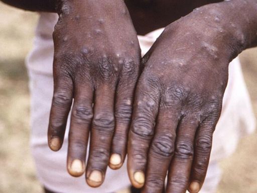 Mpox may be declared a global health emergency today. Here’s why