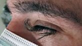 Man's eyelashes grew half an inch & developed dramatic curl after chemotherapy