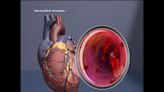 1 in 3 adults with Type 2 diabetes may have undetected cardiovascular disease