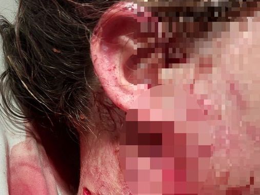 Girl, 10, left seriously injured after attack by unregistered XL bully in South Yorkshire