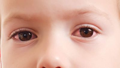 Causes and symptoms of myopia in children: Expert tips to correct vision, prevent eye strain