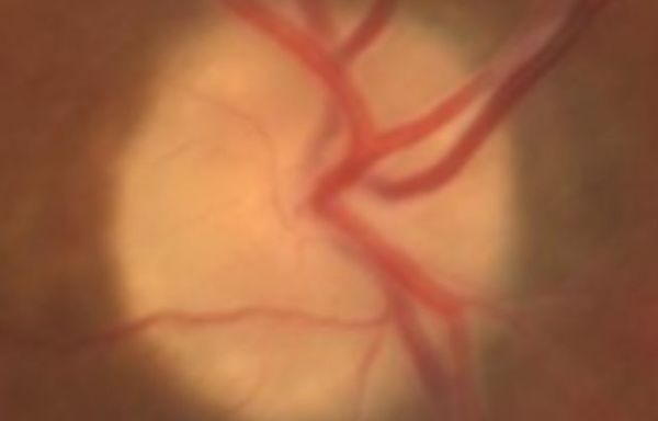 Ozempic-Like Drugs 'Tentatively' Linked With Sudden Vision Loss Risk